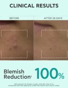 Apivita Just Bee Clear Purifying Cleanser Gel tisztító gél az arcbőrre pattanások ellen 200 ml