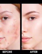 Arval Puractiva Acness tisztító balzsam 30 ml