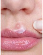 breakout + aid Emergency Dots For Spots and Blemishes helyi ápolás pattanások ellen az arcra dekoltázsra és hátra teafaolajjal 72 db