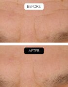 Cocunat Clinical Beauty Filler öregedés elleni arcszérum mikrotűkkel 5 ml