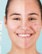 Dermedic Normacne Therapy helyi ápolás pattanások ellen 15 g