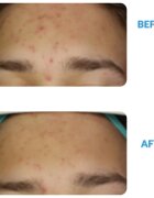 Dermedic Redness Calm krém a bőrpír és a kitágult erek ellen 40 ml