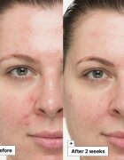 Dr. Jart+ Cicapair™ So Soothing Treatment helyi ápolás semlegesíti a bőrpírt 30 ml