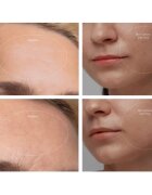 FOREO KIWI™ Derma berendezés gyémánt mikrodermabrázióhoz és pórustisztításhoz 1 db