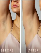FOREO PEACH™ 2 szőrnövekedés-megelőző IPL rendszer Peach 1 db