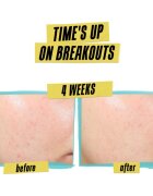 Kiehl's Dermatologist Solutions Expertly Clear Blemish-Treating & Preventing Lotion arckrém az aknés bőrre hölgyeknek 60 ml
