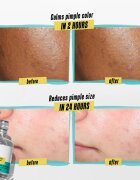 Kiehl's Dermatologist Solutions Truly Targeted Blemish-Clearing Solution szérum az aknés bőrre hölgyeknek 15 ml