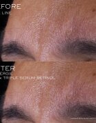 Lancôme Rénergie CRX Triple Serum Retinol bőr szérum 20 ml