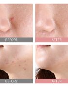 Mizon Good Bye Blemish Pink Spot szérum az aknék helyi kezelésére. pattanások ellen 19 ml