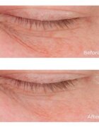 Perricone MD Cold Plasma Plus+ Eye Cream tápláló szemkrém a duzzanatokra és a sötét karikákra 15 ml