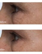Perricone MD Cold Plasma Plus+ Eye Cream tápláló szemkrém a duzzanatokra és a sötét karikákra 15 ml
