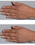 Perricone MD Cold Plasma Plus+ Hand Therapy ápoló kézkrém 59 ml