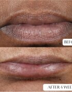 Perricone MD Cold Plasma Plus+ Lip Therapy tápláló és hidratáló ajakbalzsam 4 ml
