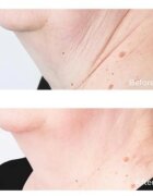 Perricone MD Cold Plasma Plus+ Sub-D/Neck feszesítő krém nyakra és dekoltázsra 59 ml
