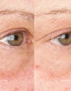 Perricone MD Hypoallergenic Clean Correction Eye Cream hidratáló és élénkítő ápolás a szemhéjakra és a szem körüli részekre 15 ml