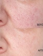 Perricone MD Hypoallergenic Clean Correction Smoothing Restorative Serum tápláló és hidratáló szérum az arcbőr élénkítésére 59 ml