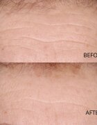 Perricone MD Hypoallergenic Clean Correction Smoothing Restorative Serum tápláló és hidratáló szérum az arcbőr élénkítésére 59 ml