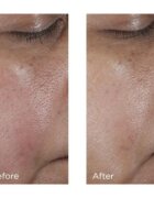 Perricone MD No:Rinse Pore Minimizing Toner intenzív tonik a bőr kisimításáért és a pórusok minimalizásáért 118 ml