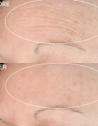 StriVectin Anti-Wrinkle SD Advanced Plus koncentrált ránctalanító krém 118 ml