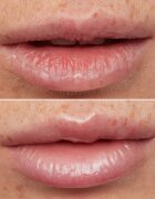 WONDERSKIN Lip Rehab Therapy Oil ajak olaj hidratáló hatással árnyalat Clear 357 ml