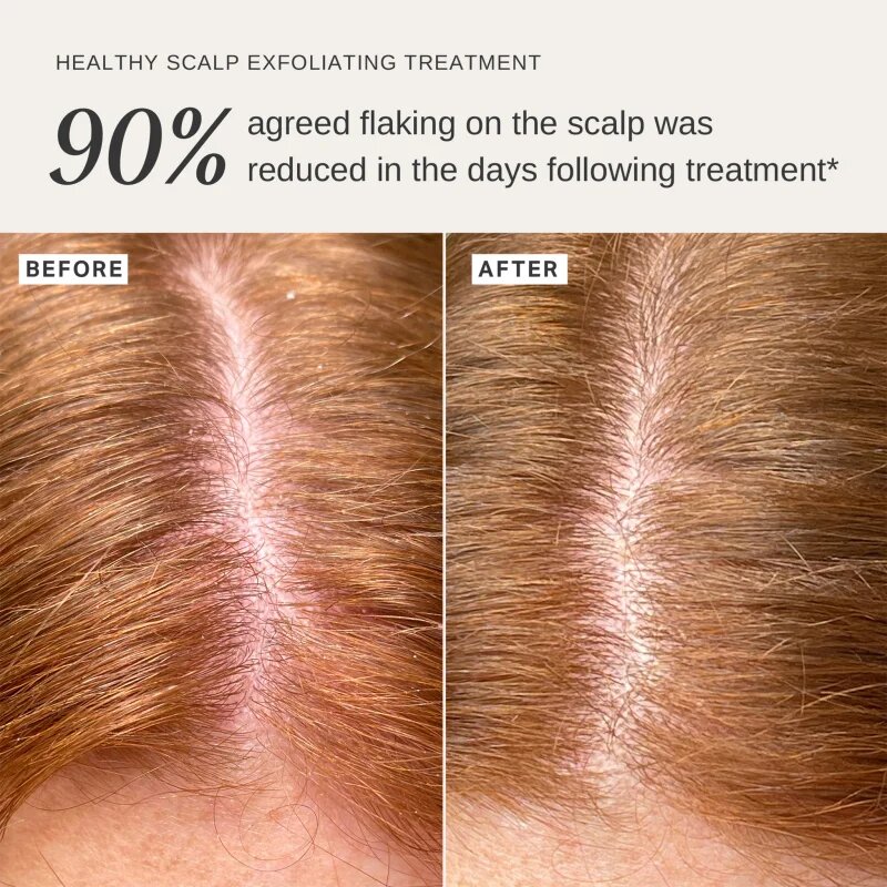 Alpha-H Healthy Scalp hámlasztó oldat fejre 100 ml