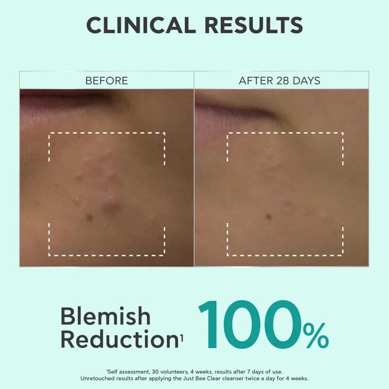 Apivita Just Bee Clear Purifying Cleanser Gel tisztító gél az arcbőrre pattanások ellen 200 ml