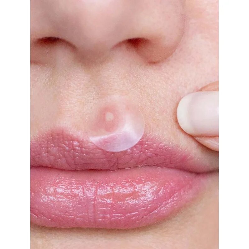 breakout + aid Emergency Dots For Spots and Blemishes helyi ápolás pattanások ellen az arcra dekoltázsra és hátra teafaolajjal 72 db