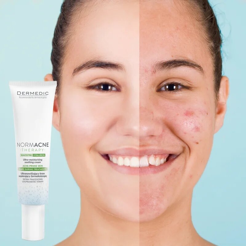 Dermedic Normacne Therapy hidratáló krém az aknés bőrre 40 ml