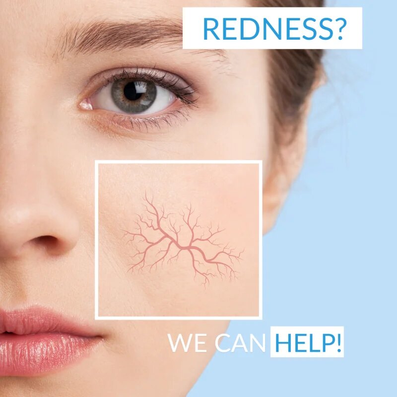 Dermedic Redness Calm krém a bőrpír és a kitágult erek ellen 40 ml