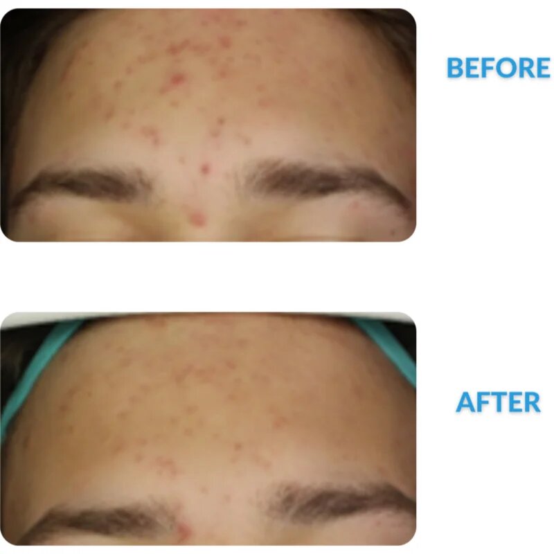 Dermedic Redness Calm krém a bőrpír és a kitágult erek ellen 40 ml