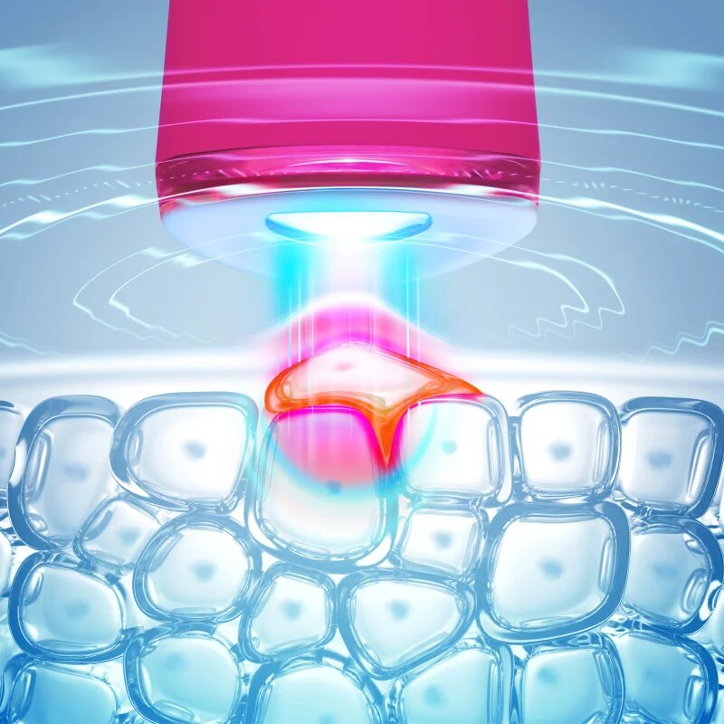 FOREO ESPADA™ 2 toll kék világítással a pattanások csökkentésére Fuchsia 1 db