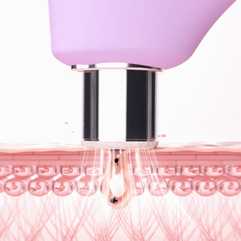FOREO KIWI™ Derma berendezés gyémánt mikrodermabrázióhoz és pórustisztításhoz 1 db