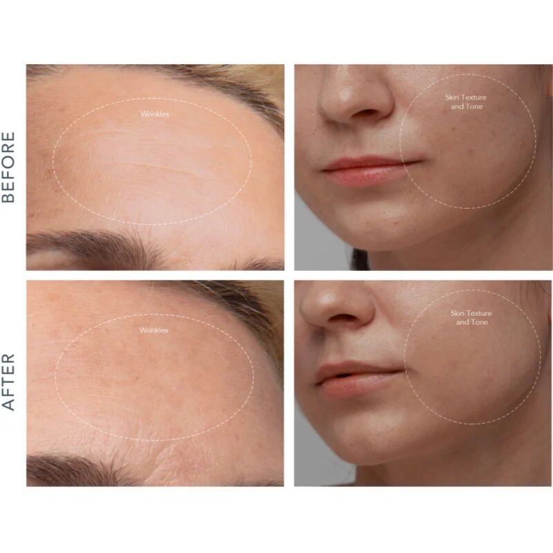 FOREO KIWI™ Derma berendezés gyémánt mikrodermabrázióhoz és pórustisztításhoz 1 db