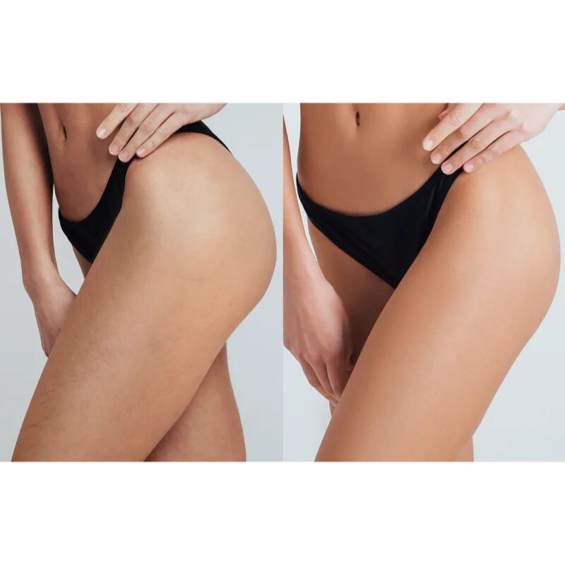 FOREO PEACH™ 2 Pro Max IPL testre arcra bikinivonalra és hónaljra hölgyeknek 1 db