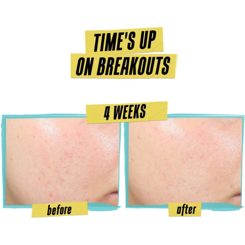 Kiehl's Dermatologist Solutions Expertly Clear Blemish-Treating & Preventing Lotion arckrém az aknés bőrre hölgyeknek 60 ml