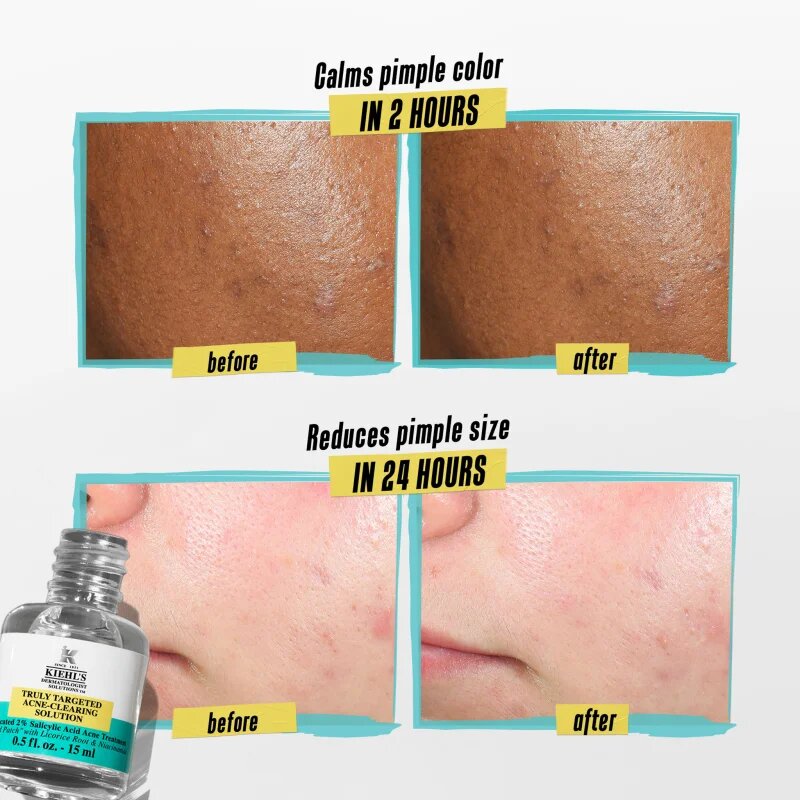 Kiehl's Dermatologist Solutions Truly Targeted Blemish-Clearing Solution szérum az aknés bőrre hölgyeknek 15 ml