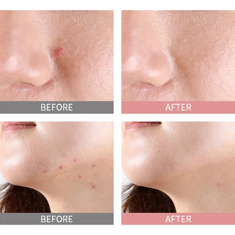 Mizon Good Bye Blemish Pink Spot szérum az aknék helyi kezelésére. pattanások ellen 19 ml