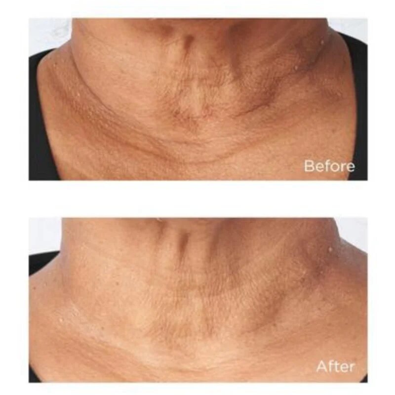 Perricone MD Cold Plasma Plus+ Sub-D/Neck feszesítő krém nyakra és dekoltázsra 59 ml