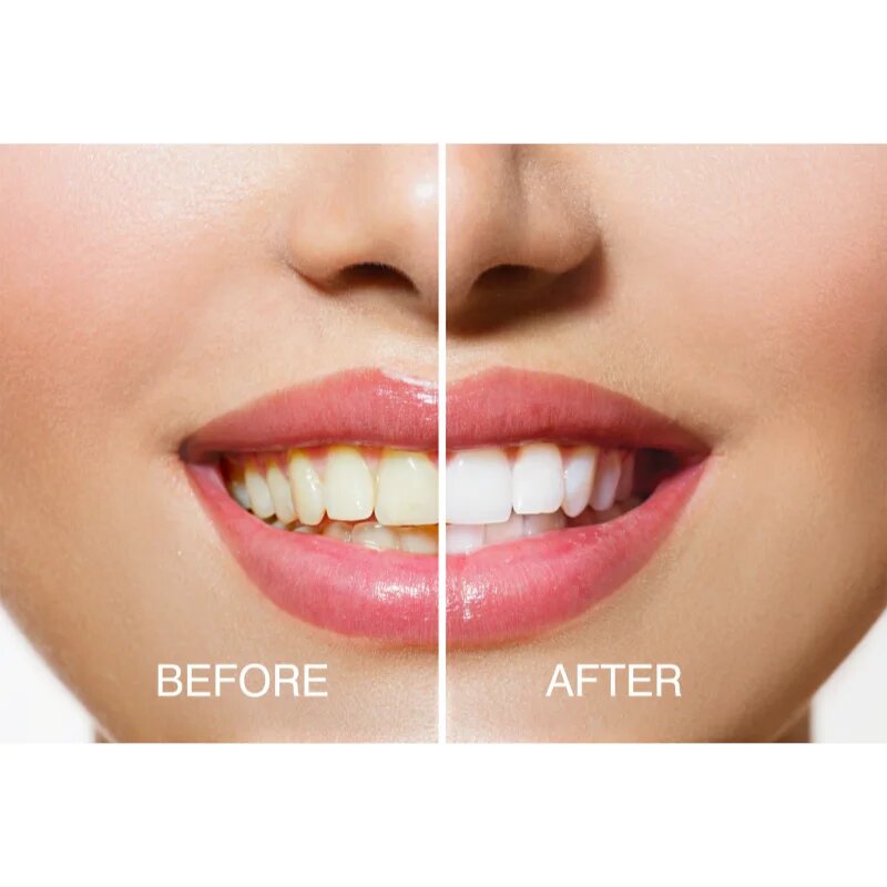 RIO USB teeth whitening fogfehérítő szett