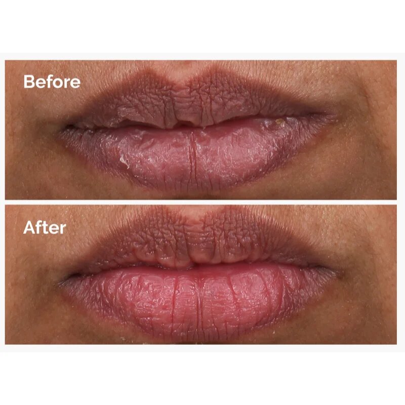 The Ordinary PHA 5% Exfoliating Lip Serum feszesítő hámlasztó szérum az ajkakra 15 ml