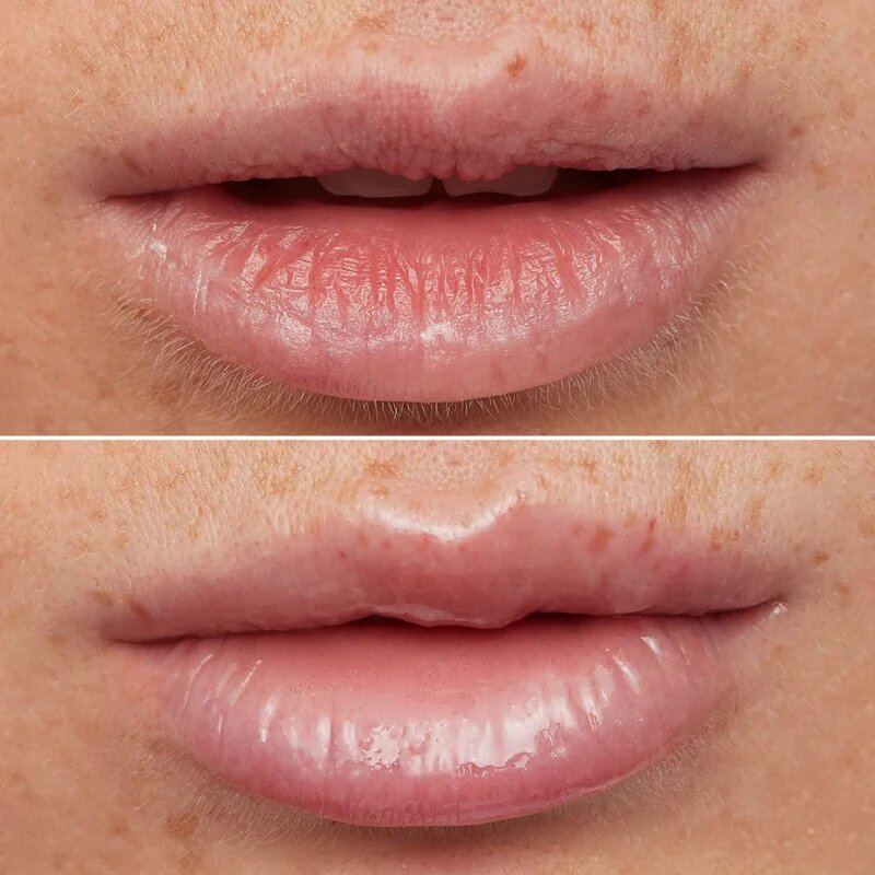 WONDERSKIN Lip Rehab Therapy Oil ajak olaj hidratáló hatással árnyalat Clear 357 ml